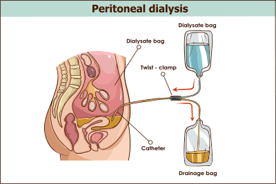 Peritoneal dialysis are both used to treat kidney